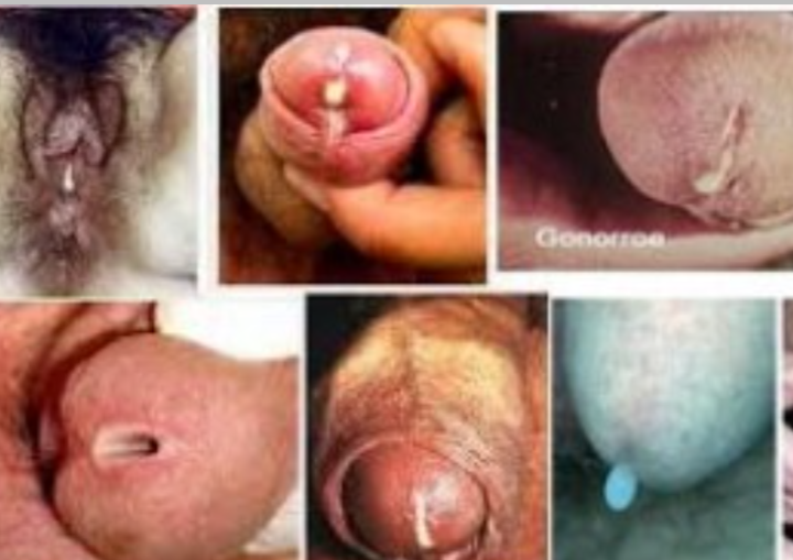 Gonore: Penyakit Menular Seksual yang Harus Diwaspadai