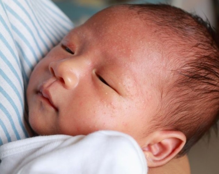 Bintik Putih pada Bayi, Ketahui Sebab dan Cara Mengatasi
