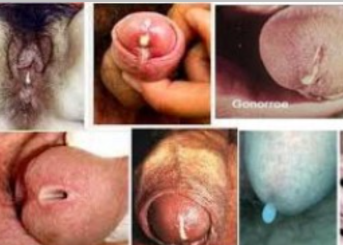 Gonore: Penyakit Menular Seksual yang Harus Diwaspadai
