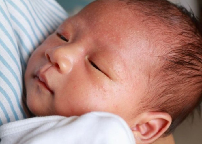 Bintik Putih pada Bayi, Ketahui Sebab dan Cara Mengatasi